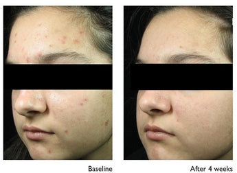 Vivier Acne Treatment Lotion